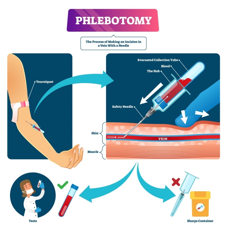 How to draw blood from a patient’s vein as painlessly as